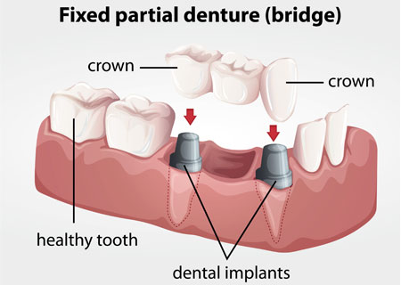 Bridges Dental Care Potomac MD, Dental Bridges, Dental Treatment MD