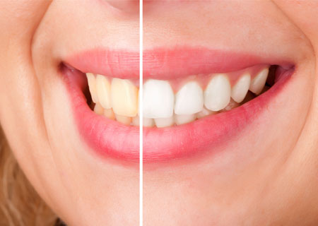 Teeth Whitening | Potomac Dental Clinic