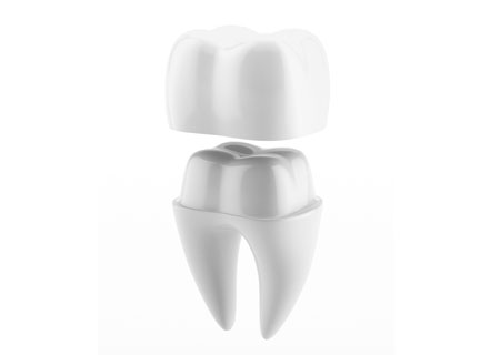 Crowns | Potomac Dental Clinic